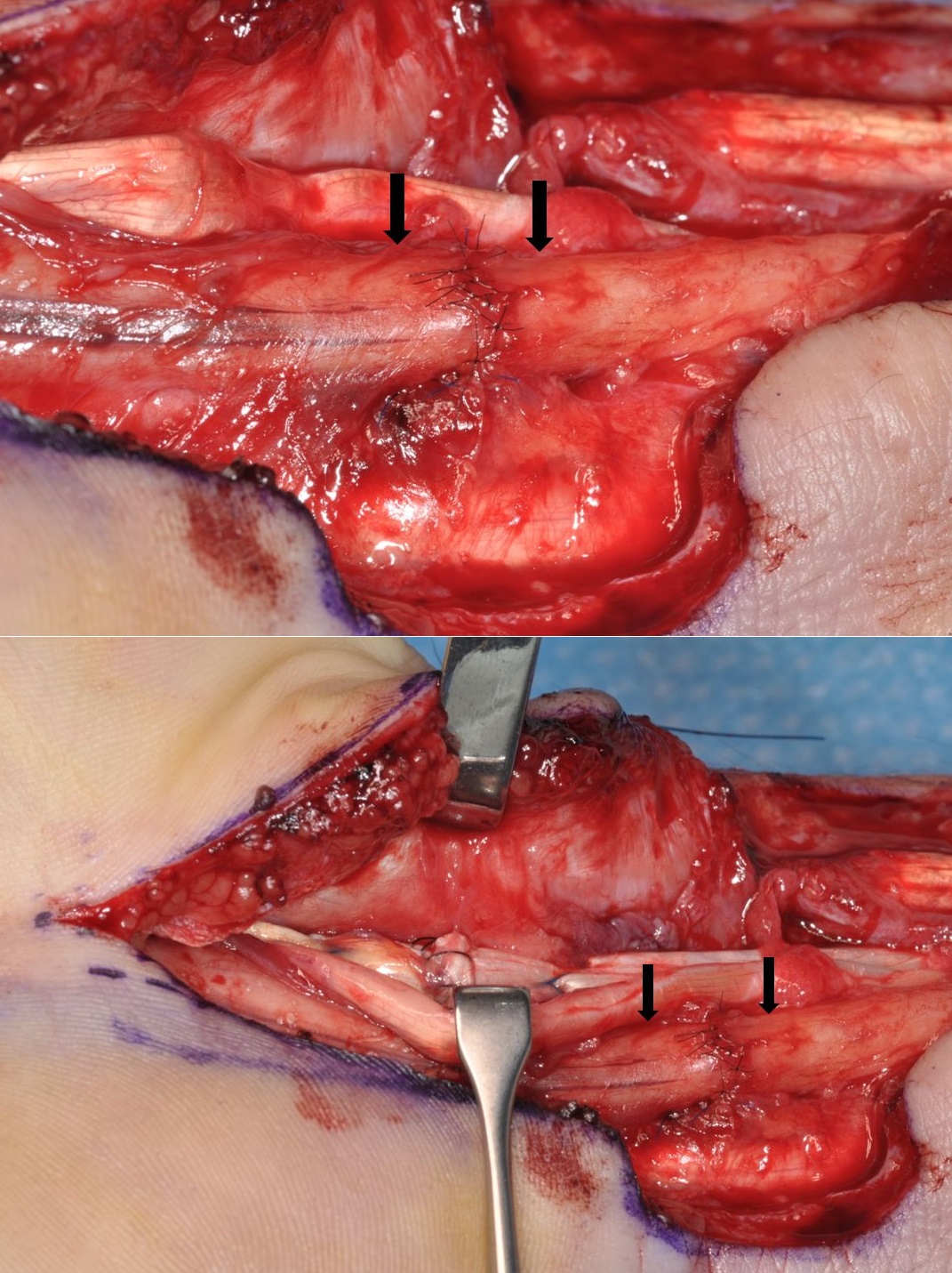 Suture repair of the median nerve at the wrist. 