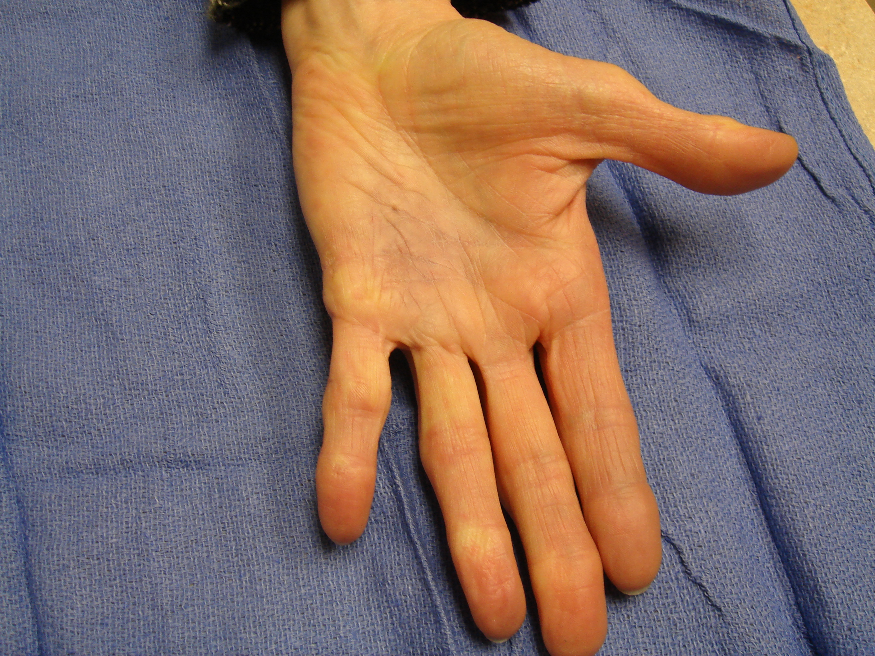 Figure 1h: These photographs illustrate the patient’s hand 6 months after the second enzyme treatment cycle (for the fourth ray) and 15 months.