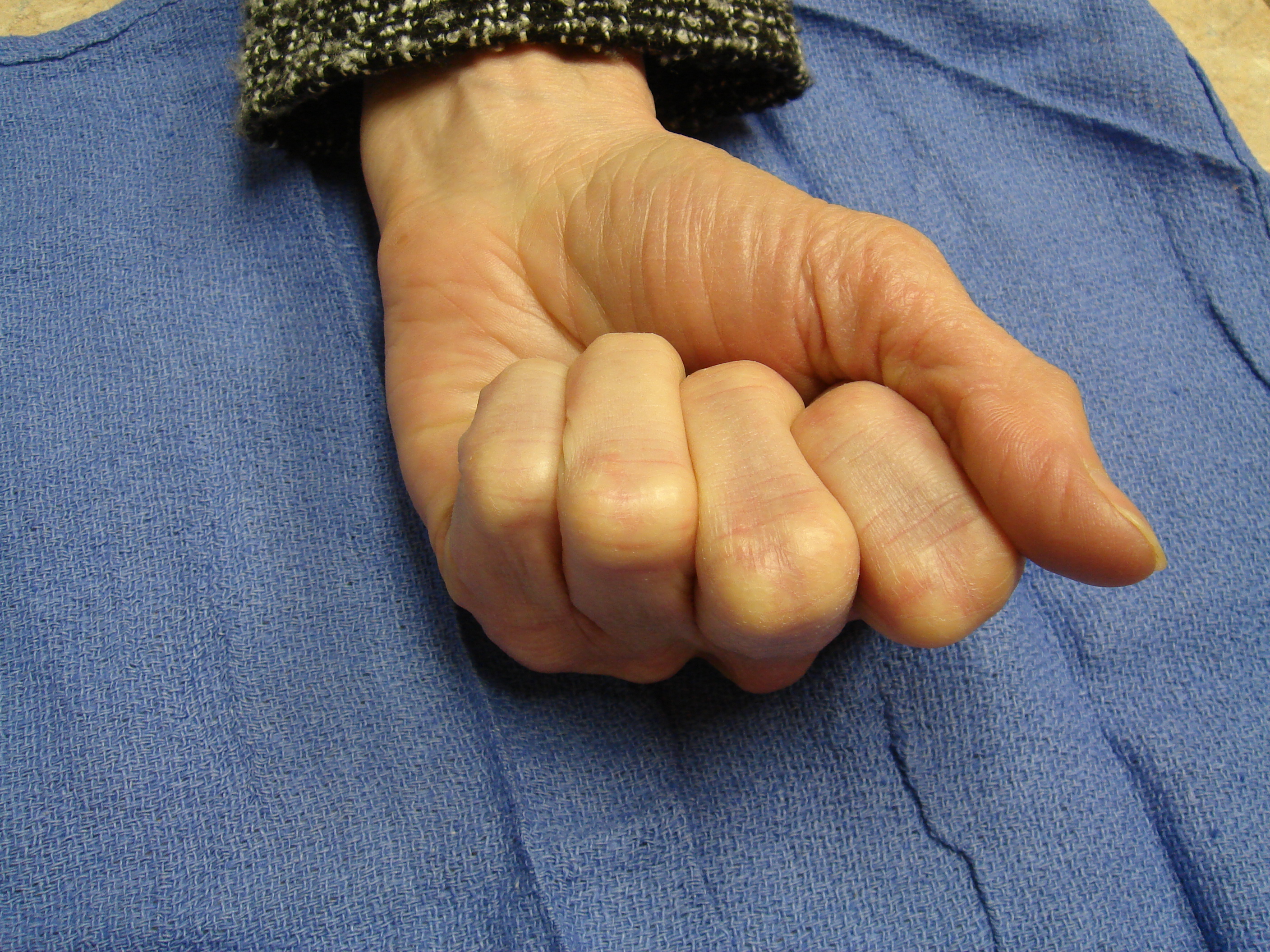 Figure 1i: These photographs illustrate the patient’s hand 6 months after the second enzyme treatment cycle (for the fourth ray) and 15 months.
