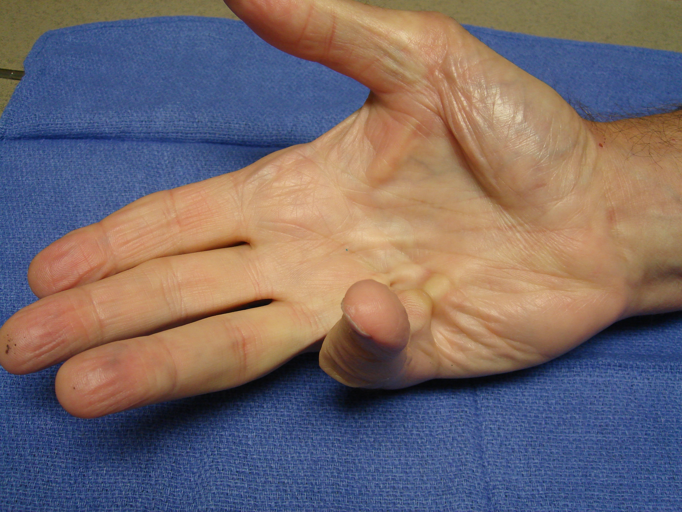 Figure 2a: This patient had a combined little finger MP and PIP contracture plus a Y-cord (natatory cord) into the ring finger.