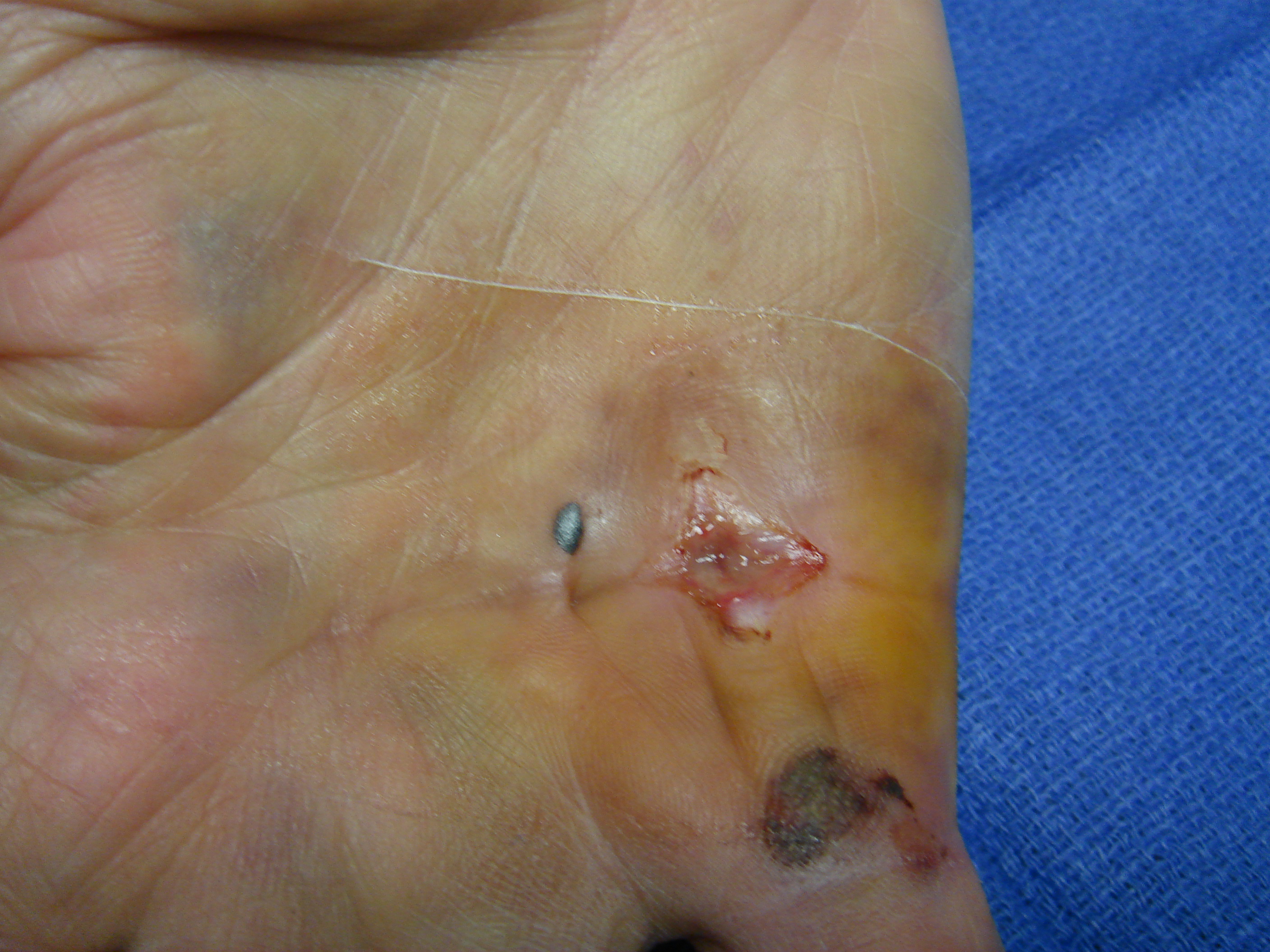 Figure 2c: These photographs illustrate the patient’s hand 7 days post-enzyme injection. The custom thermoplastic night splint is shown; the palmar skin tear and MP crease bruise are healing.