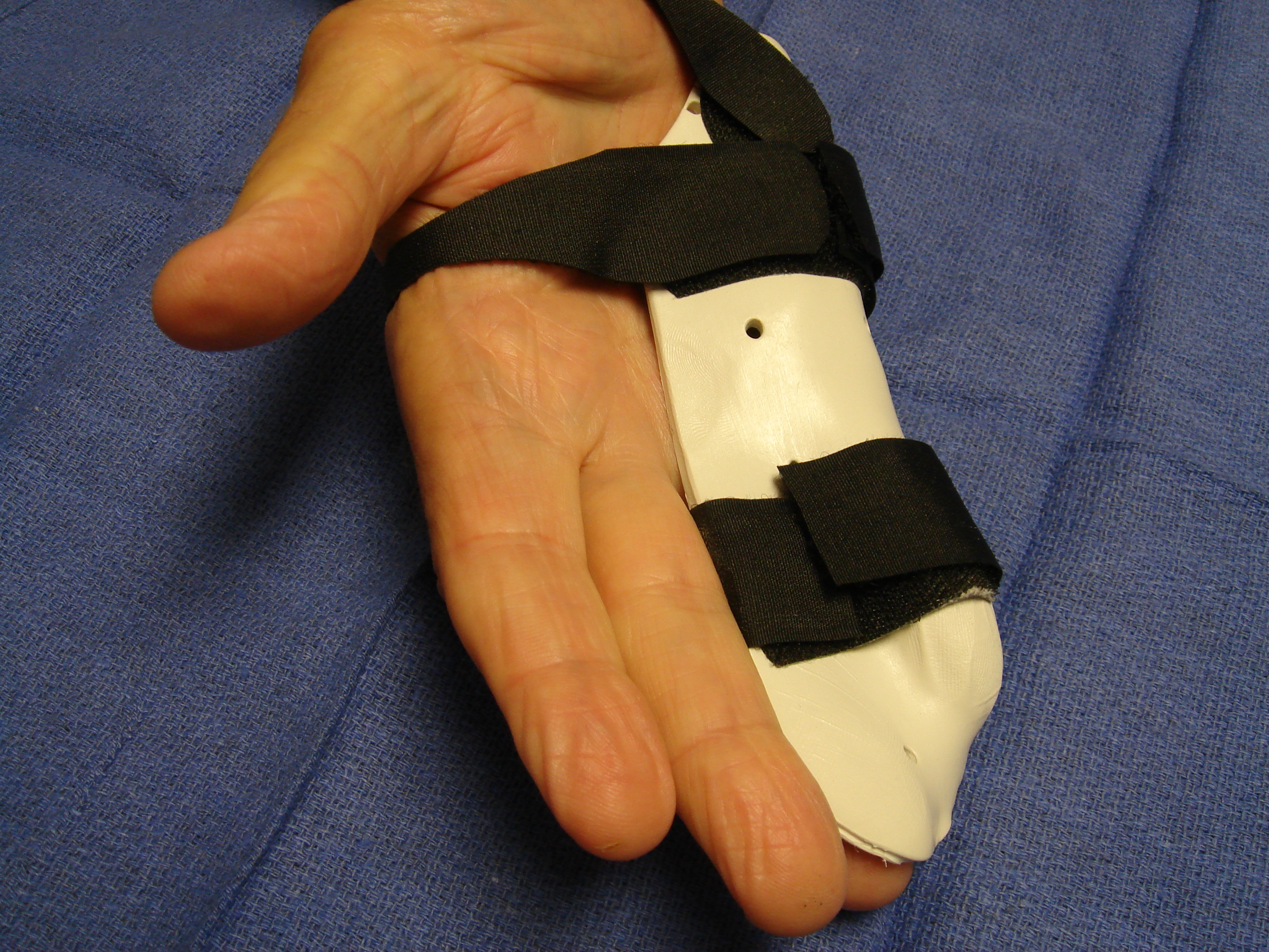 Figure 2d: These photographs illustrate the patient’s hand 7 days post-enzyme injection. The custom thermoplastic night splint is shown; the palmar skin tear and MP crease bruise are healing.