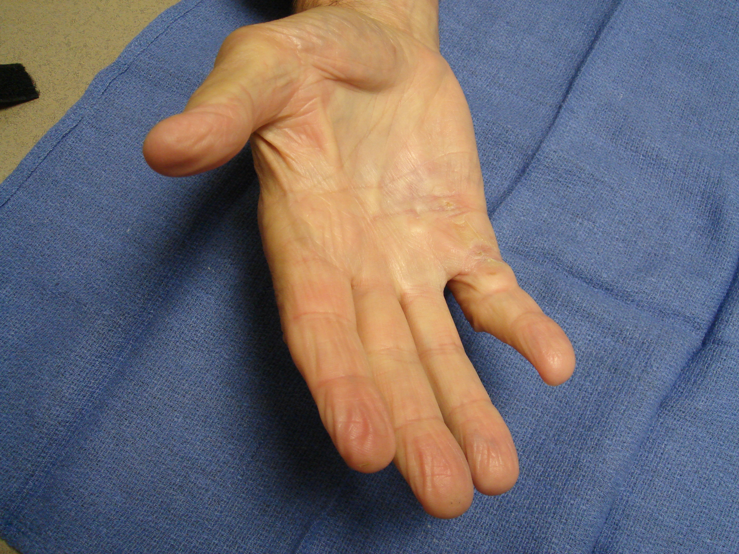 Figure 2e: At 90 days post-treatment he has full motion.