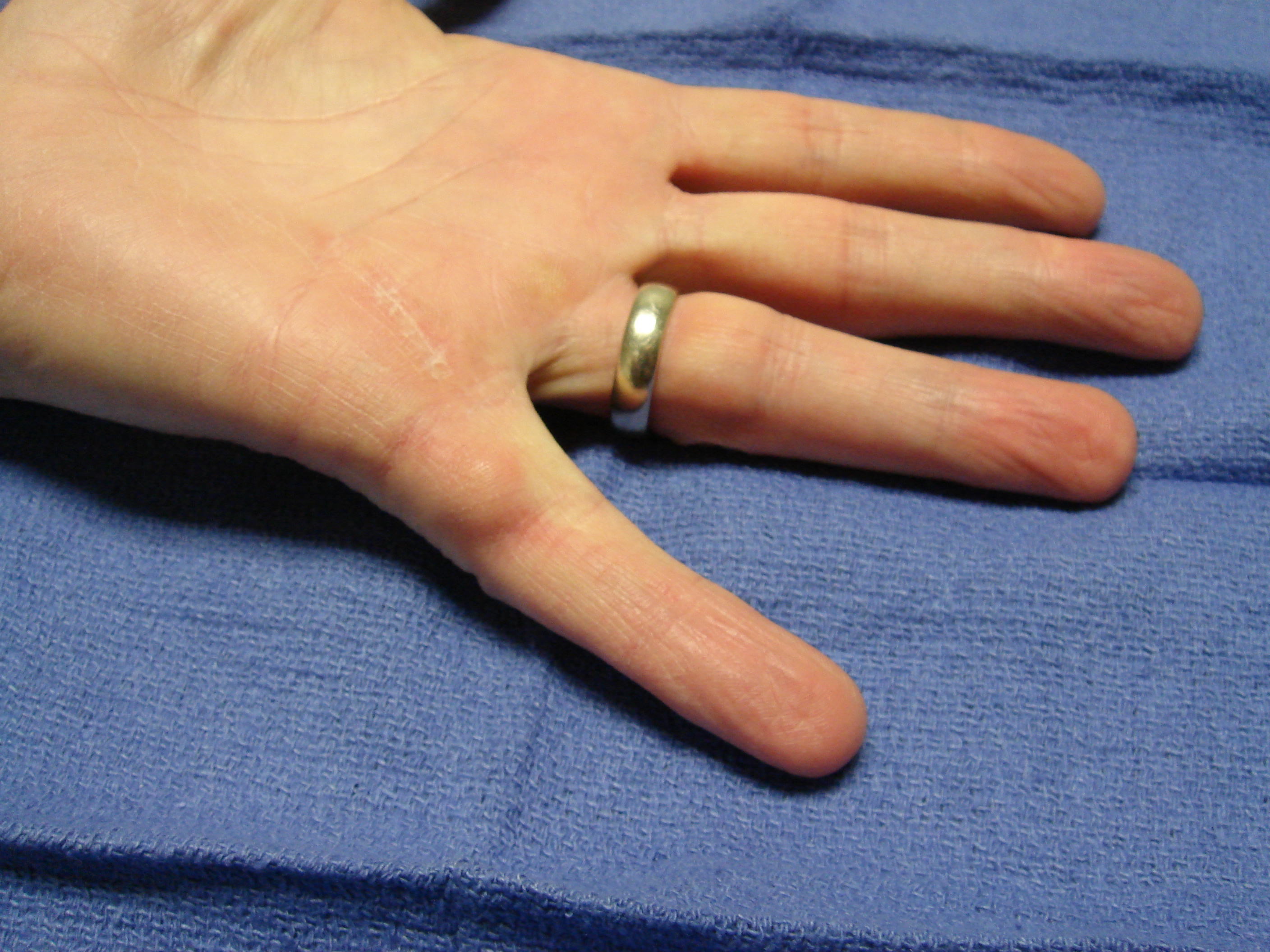 Figure 3d: Six months after collagenase treatment the patient maintains full active motion. A proximal phalangeal fascial nodule is seen slightly enlarged from pre-treatment; but there is yet no new contracture.