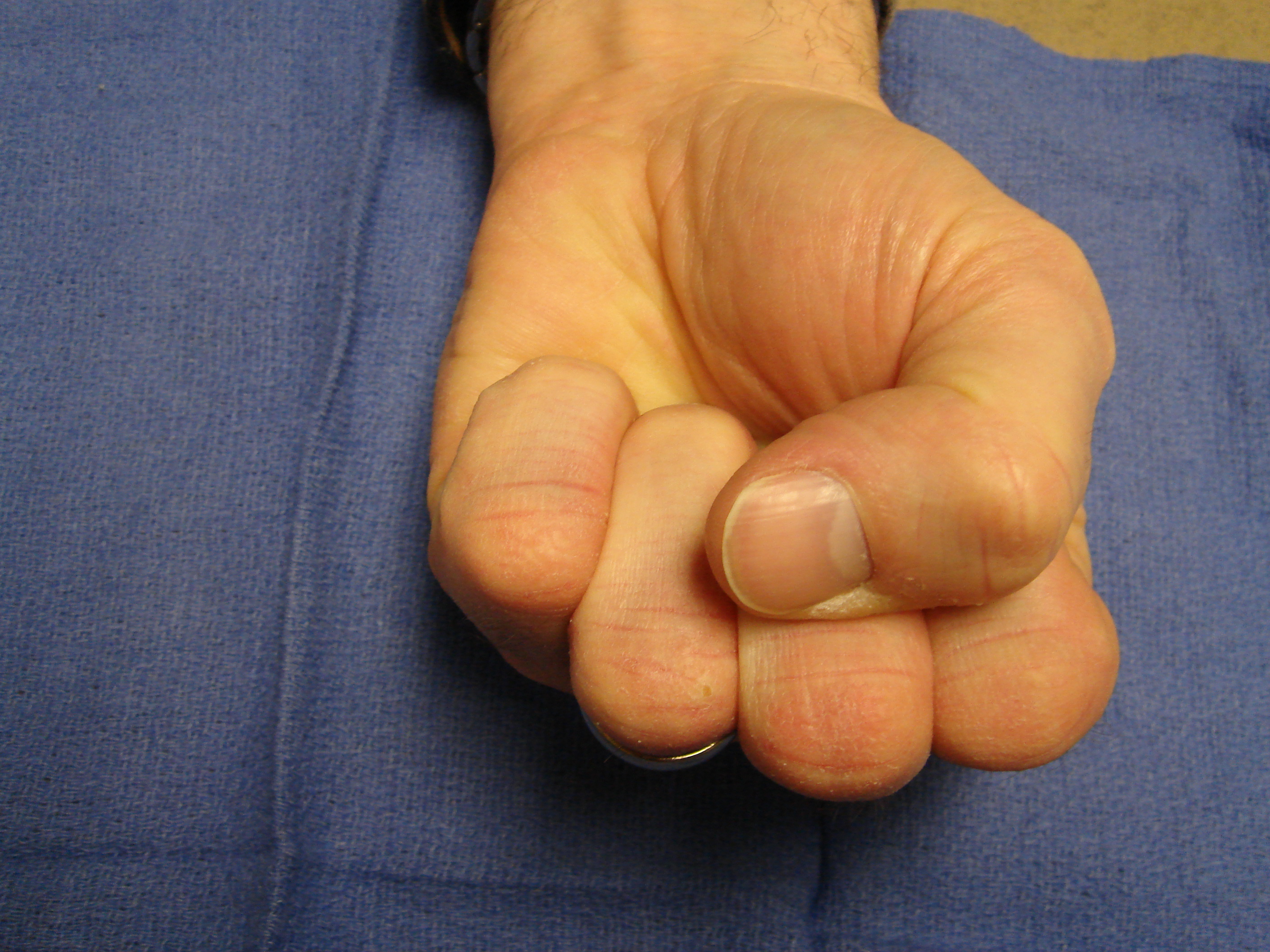 Figure 3e: Six months after collagenase treatment the patient maintains full active motion. A proximal phalangeal fascial nodule is seen slightly enlarged from pre-treatment; but there is yet no new contracture.