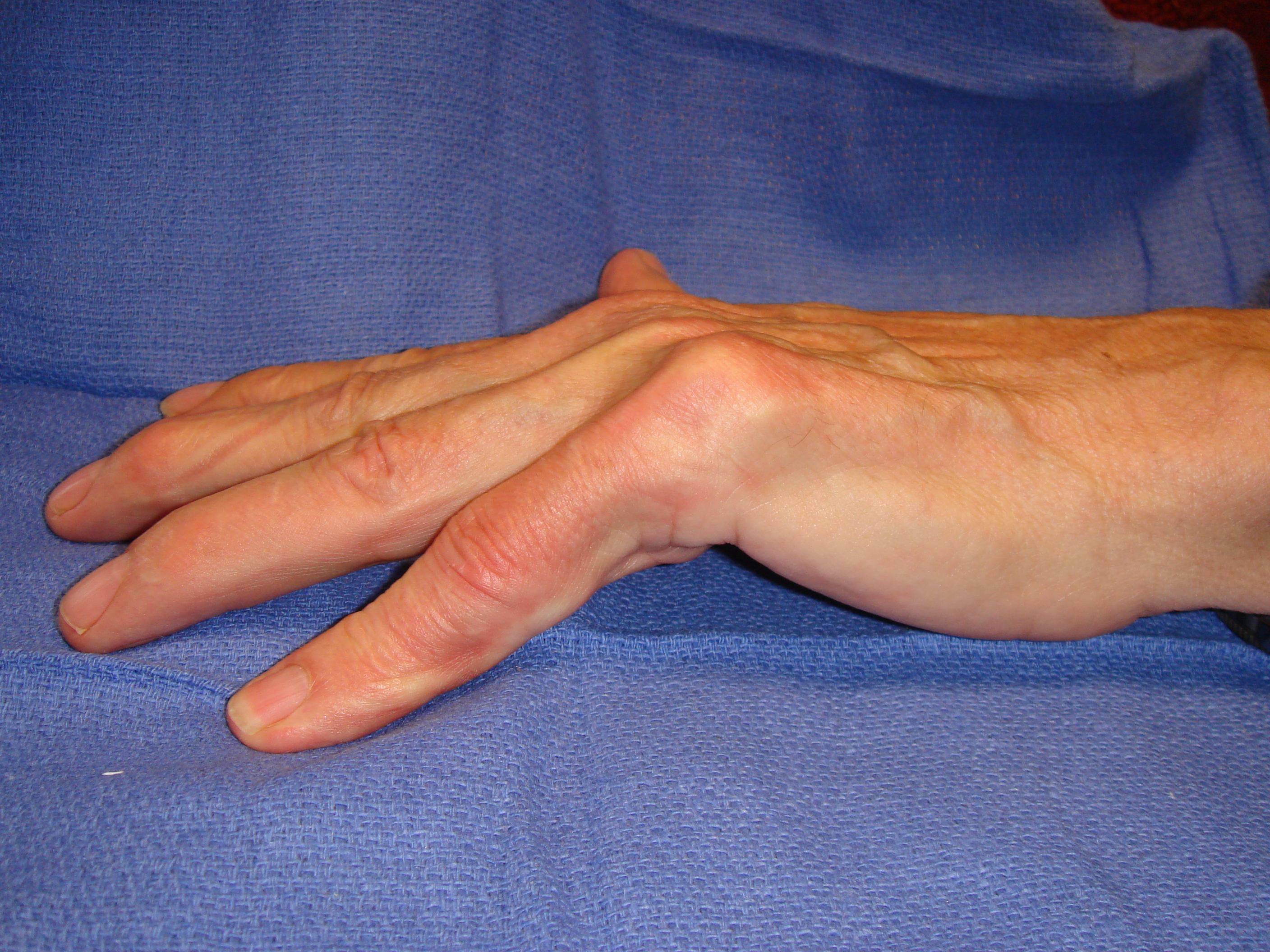 Image 4b: This ~70-year-old male had no family history of Dupuytren’s. There is a problematic cord, seen primarily in the fifth ray and that crossed towards the ring finger web.