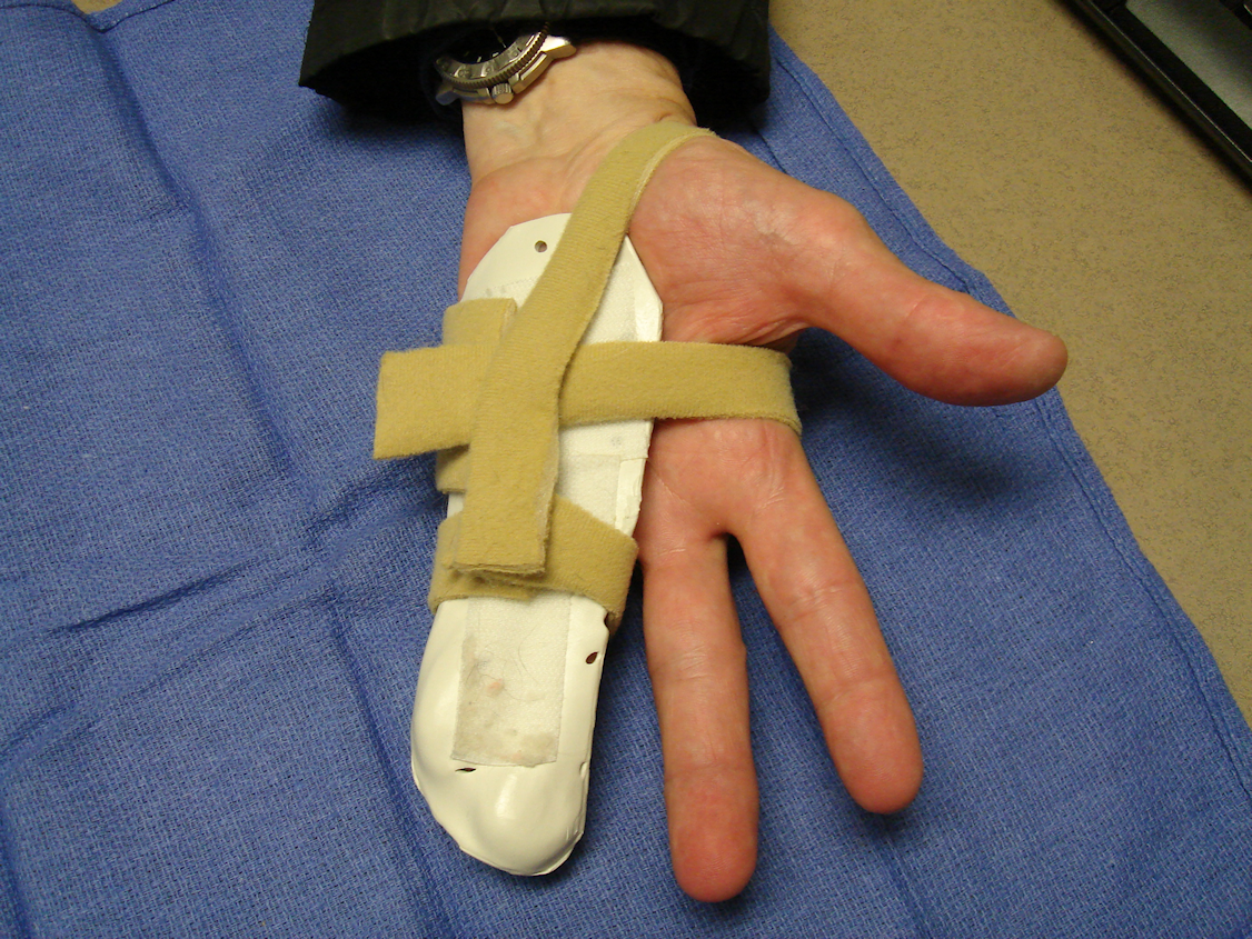Figure 4c: The patient wore a custom volar thermoplastic splint that held the ring and little finger MP and PIP joints in extension.