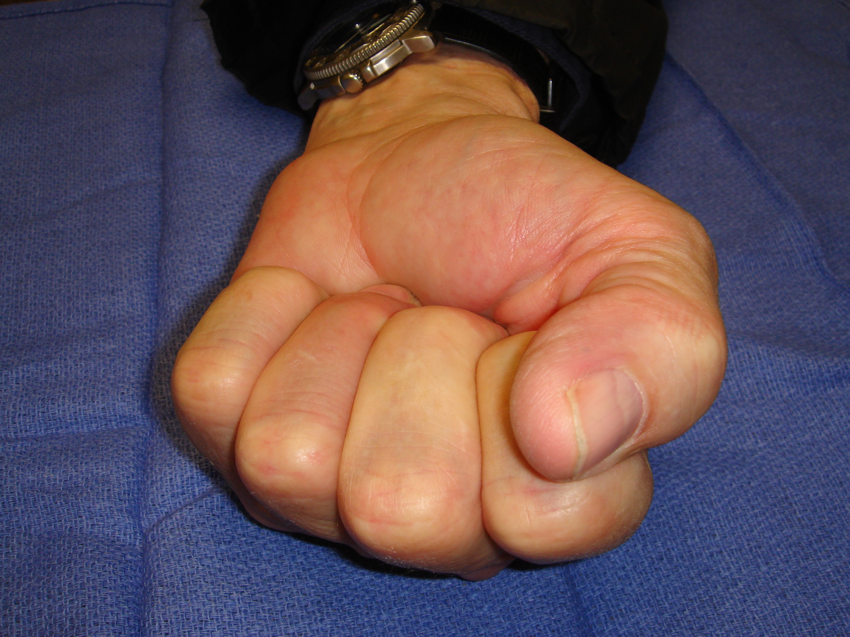 Figure 4d: He has full motion without cords or contracture 6 months post-collagenase treatment.