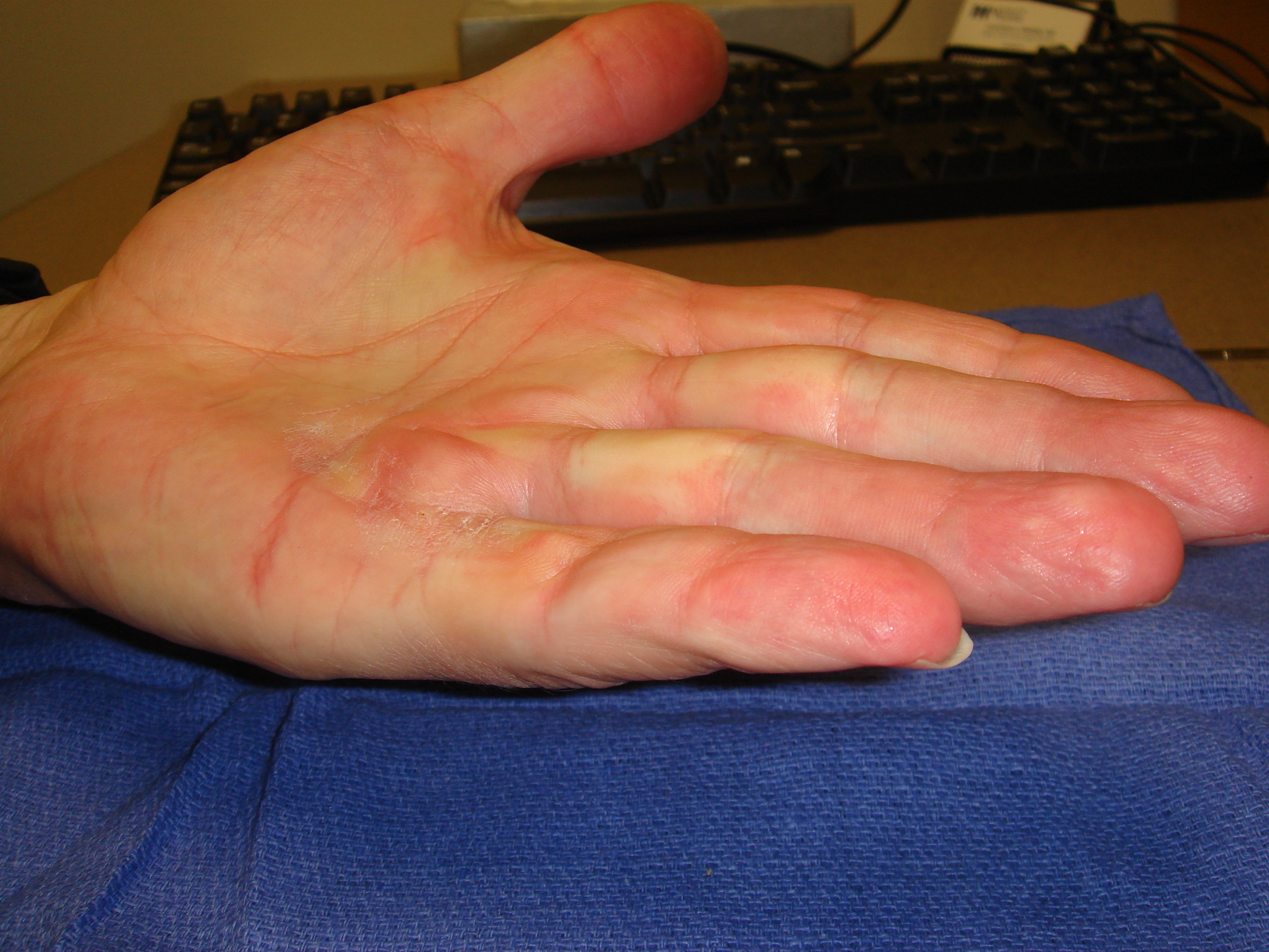 Figure 4e: He has full motion without cords or contracture 6 months post-collagenase treatment.