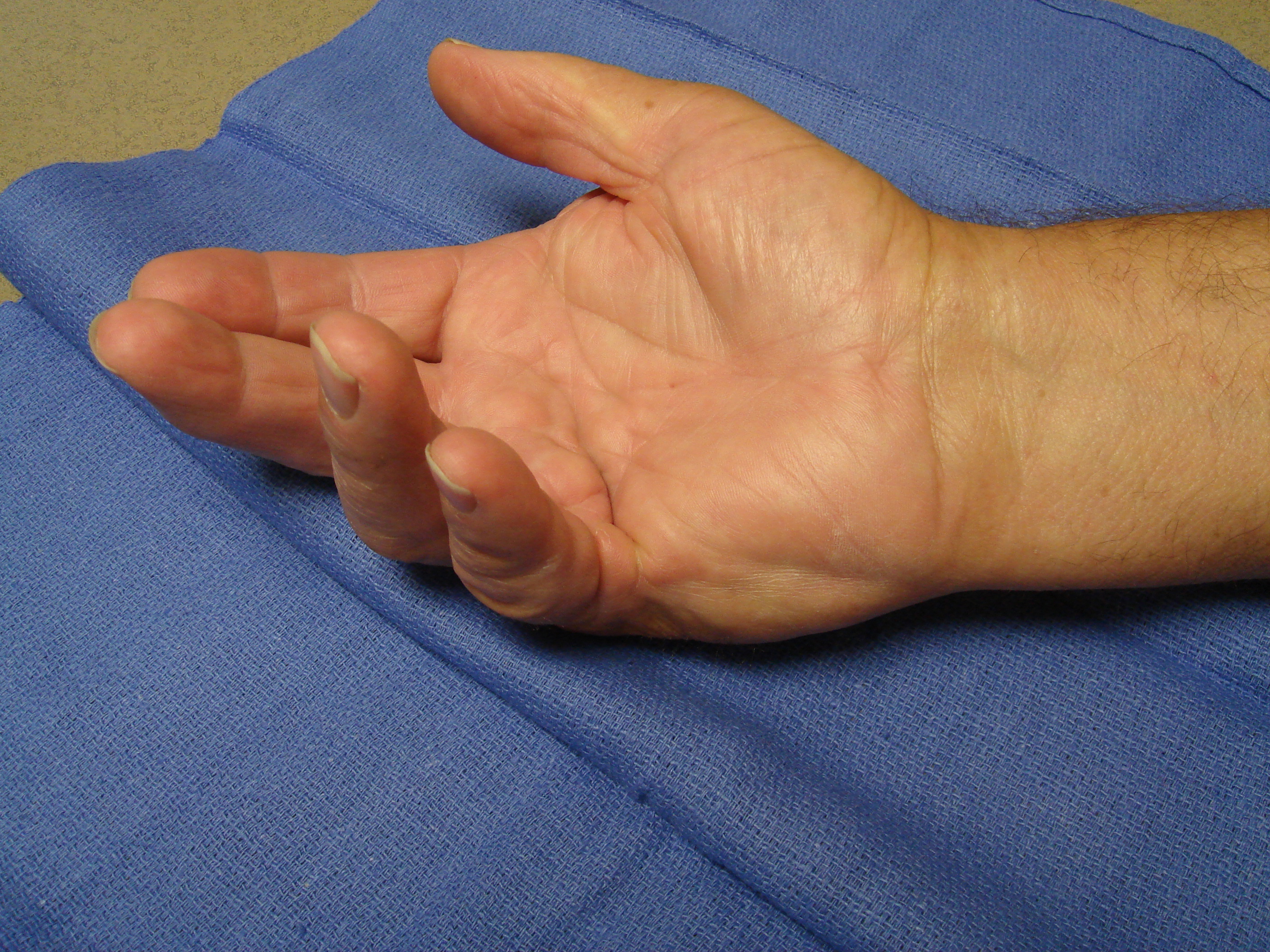 Figure 5a. The right hand of a 70-year-old man with significant, dysfunctional MP joint contractures of the ring and little fingers. He also had contractures of the contralateral left hand, but treatment was started for his dominant right side.