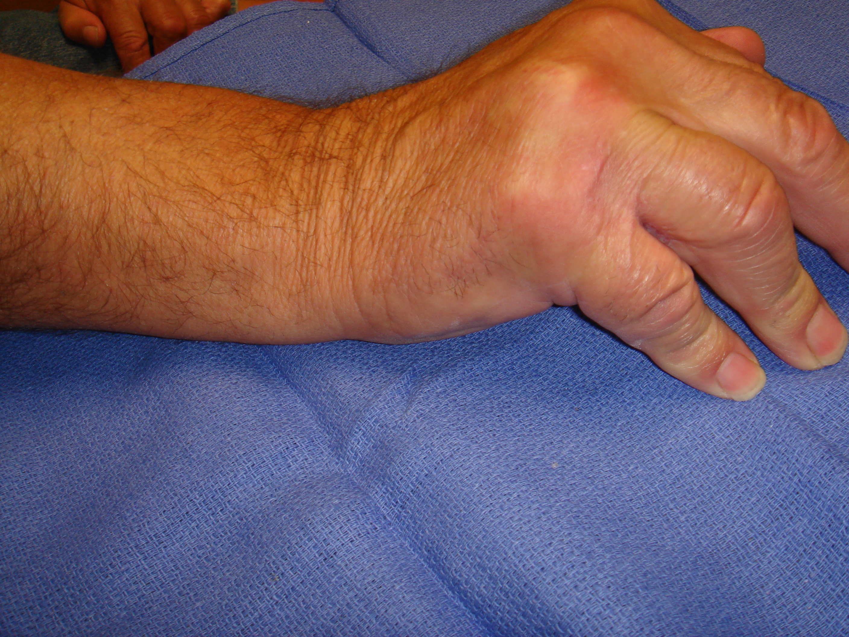 Figure 5b. The right hand of a 70-year-old man with significant, dysfunctional MP joint contractures of the ring and little fingers. He also had contractures of the contralateral left hand, but treatment was started for his dominant right side.