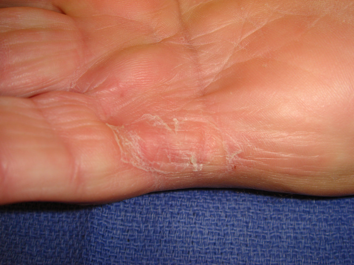 Figure 5c: Bruising and swelling have completely resolved and full motion is evident 6 weeks post-collagenase treatment.
