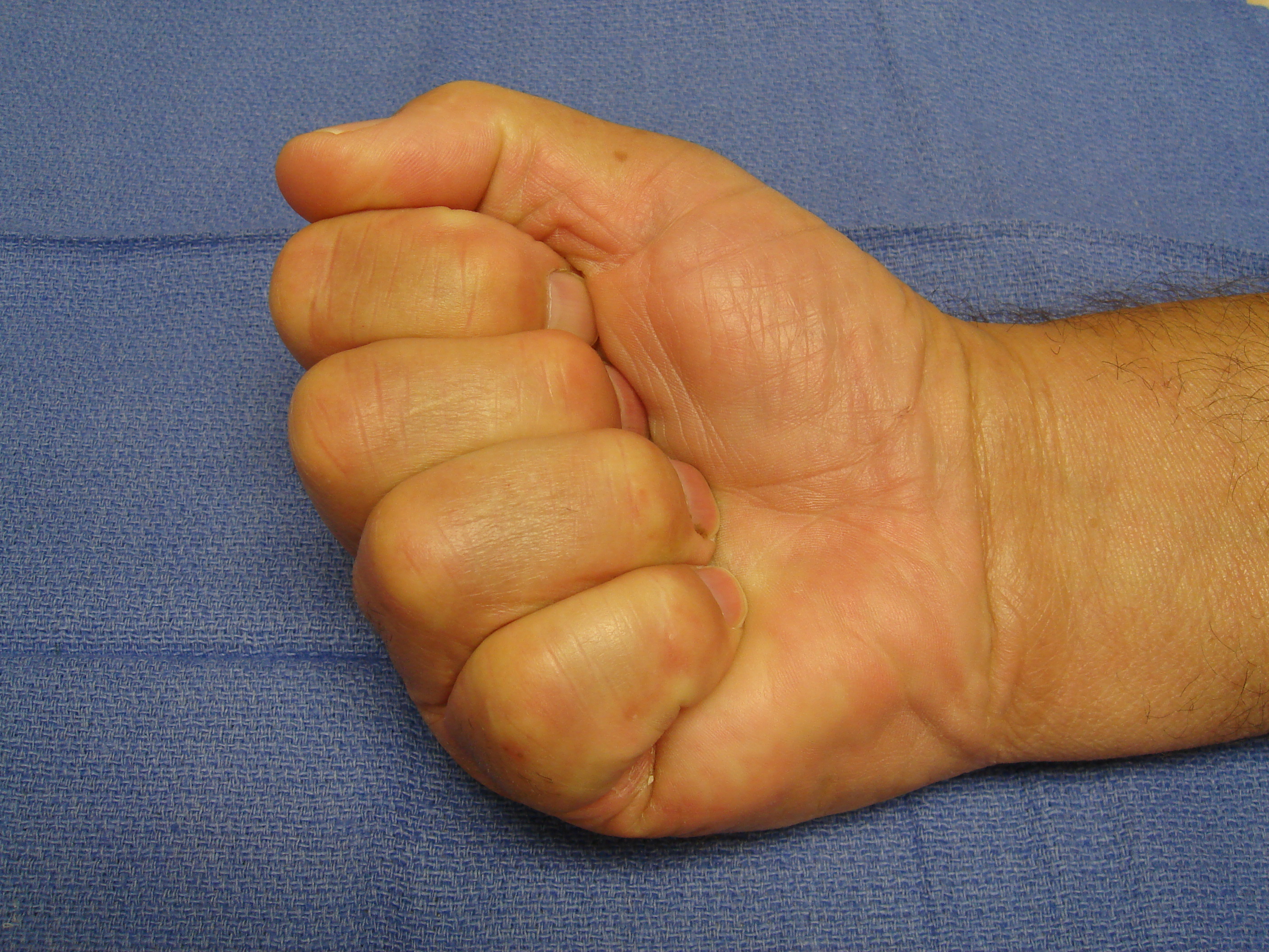 Figure 5d: Bruising and swelling have completely resolved and full motion is evident 6 weeks post-collagenase treatment.
