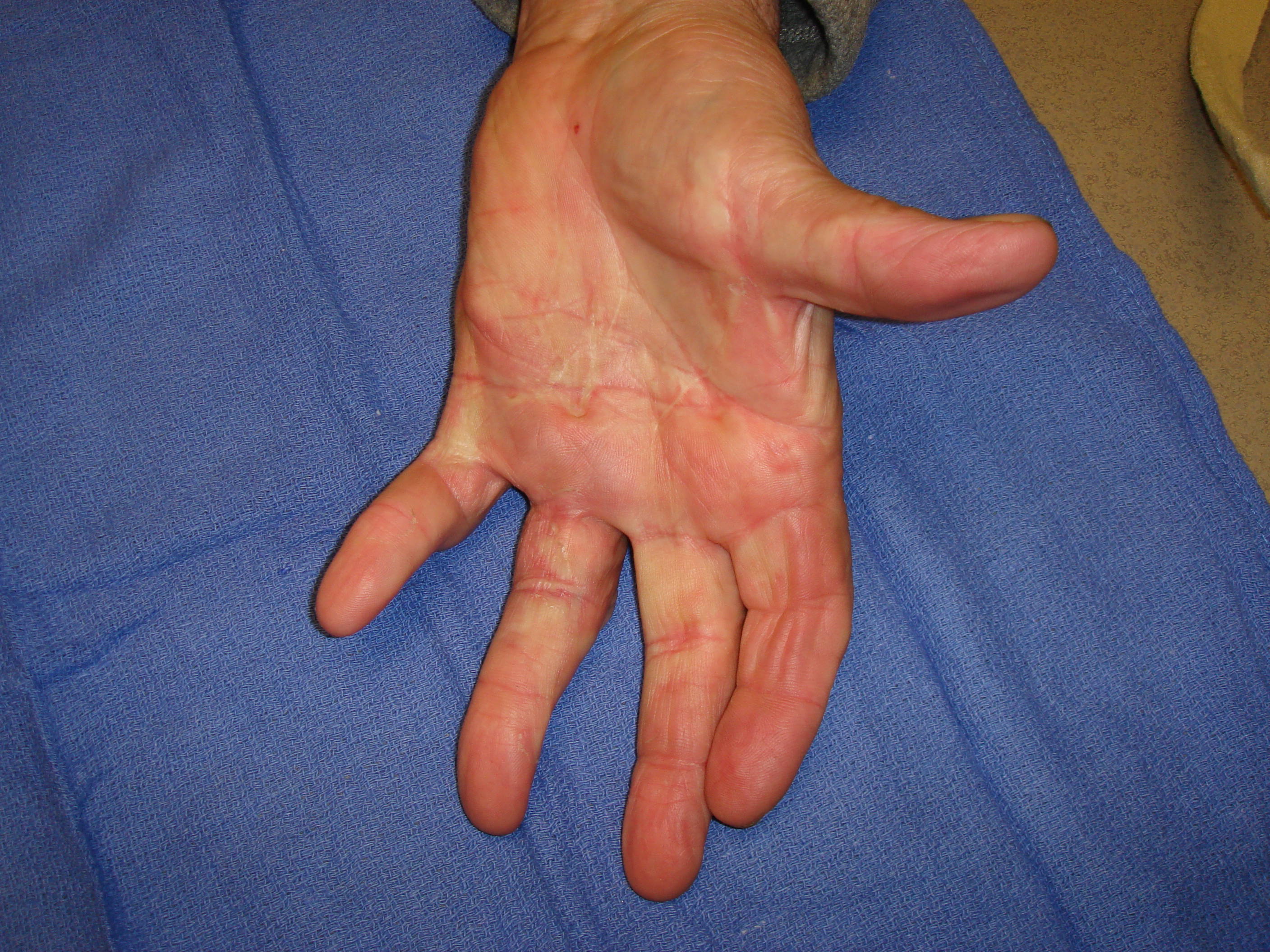 Figure 6i: These images were about 180 days after he completed his second collagenase treatment cycle that addressed the untreated/residual ring finger contractures. While some deformity persists, especially in the little finger PIP joint, he is quite functional and happy with his result.