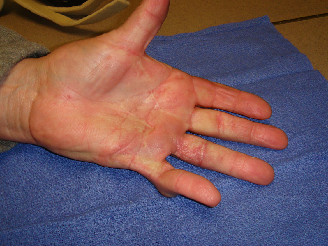 Figure 6j: These images were about 180 days after he completed his second collagenase treatment cycle that addressed the untreated/residual ring finger contractures. While some deformity persists, especially in the little finger PIP joint, he is quite functional and happy with his result.