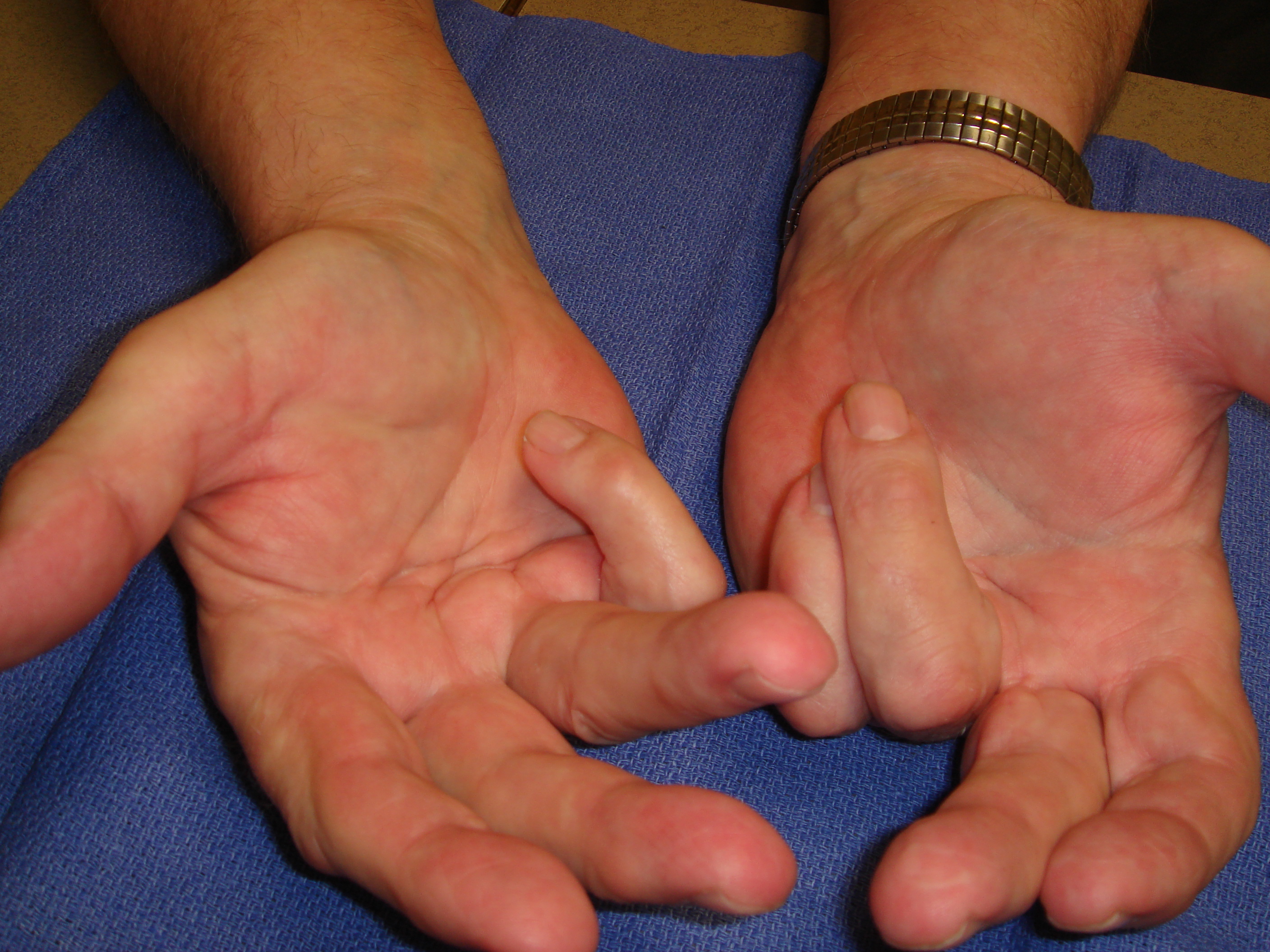 Figure 7a: This 75-year-old man presented with bilateral fourth and fifth ray recurrences of Dupuytren’s contractures 14 months after his second needle aponeurotomies in each hand. He had had the initial recurrences <9 months after the first procedures and recorded “excellent” corrections; the repeat needle aponeurotomies were also reported to have regained extension but also quickly recurred. He elected enzyme treatments beginning with his dominant right hand with the stated goal of being able to “hold my wife’s hand” again.
