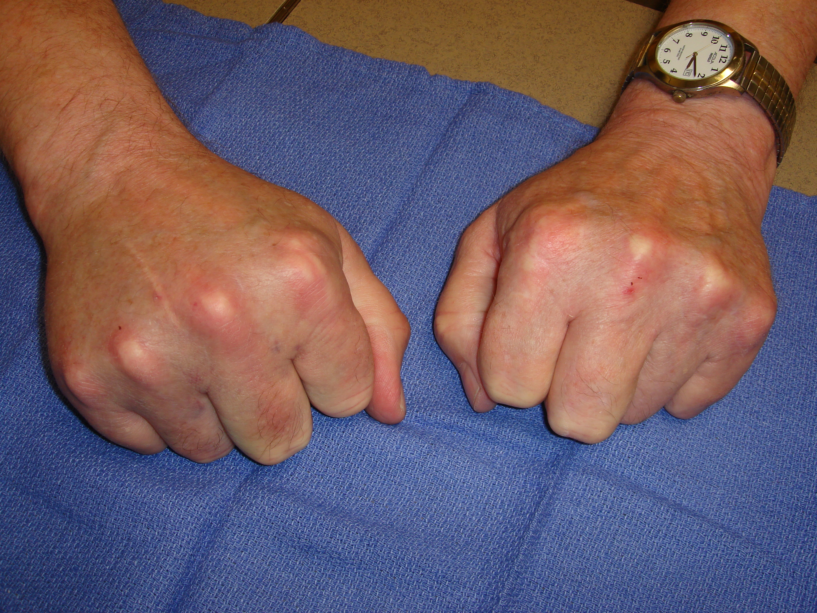 Figure 7b: At the 48-hour visit his right hand is minimally swollen; however, he also has mildly uncomfortable axillary bruising with enlarged nodes.