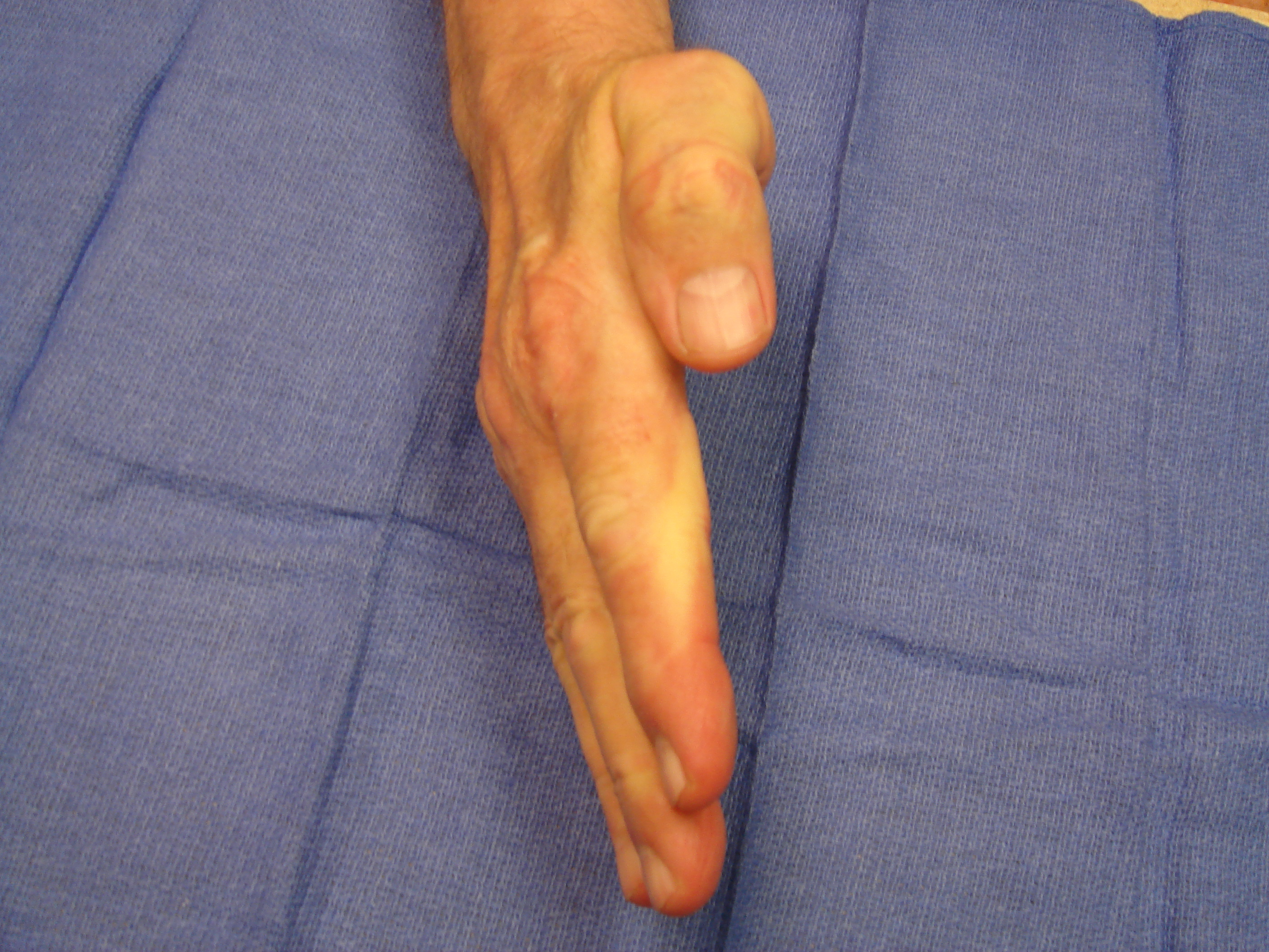 Figure 7g: One year after enzyme injection cycle #2 he has maintained finger correction and has useful active flexion (the little finger DIP joint is stiff from osteoarthritis). He reports holding his wife’s hand whenever he wants.