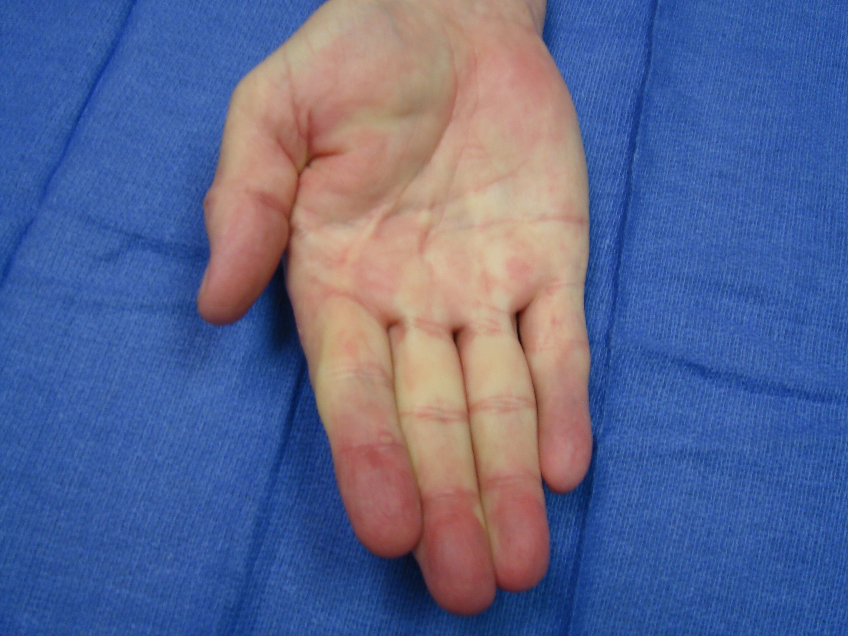 Figure 7h: One year after enzyme injection cycle #2 he has maintained finger correction and has useful active flexion (the little finger DIP joint is stiff from osteoarthritis). He reports holding his wife’s hand whenever he wants.