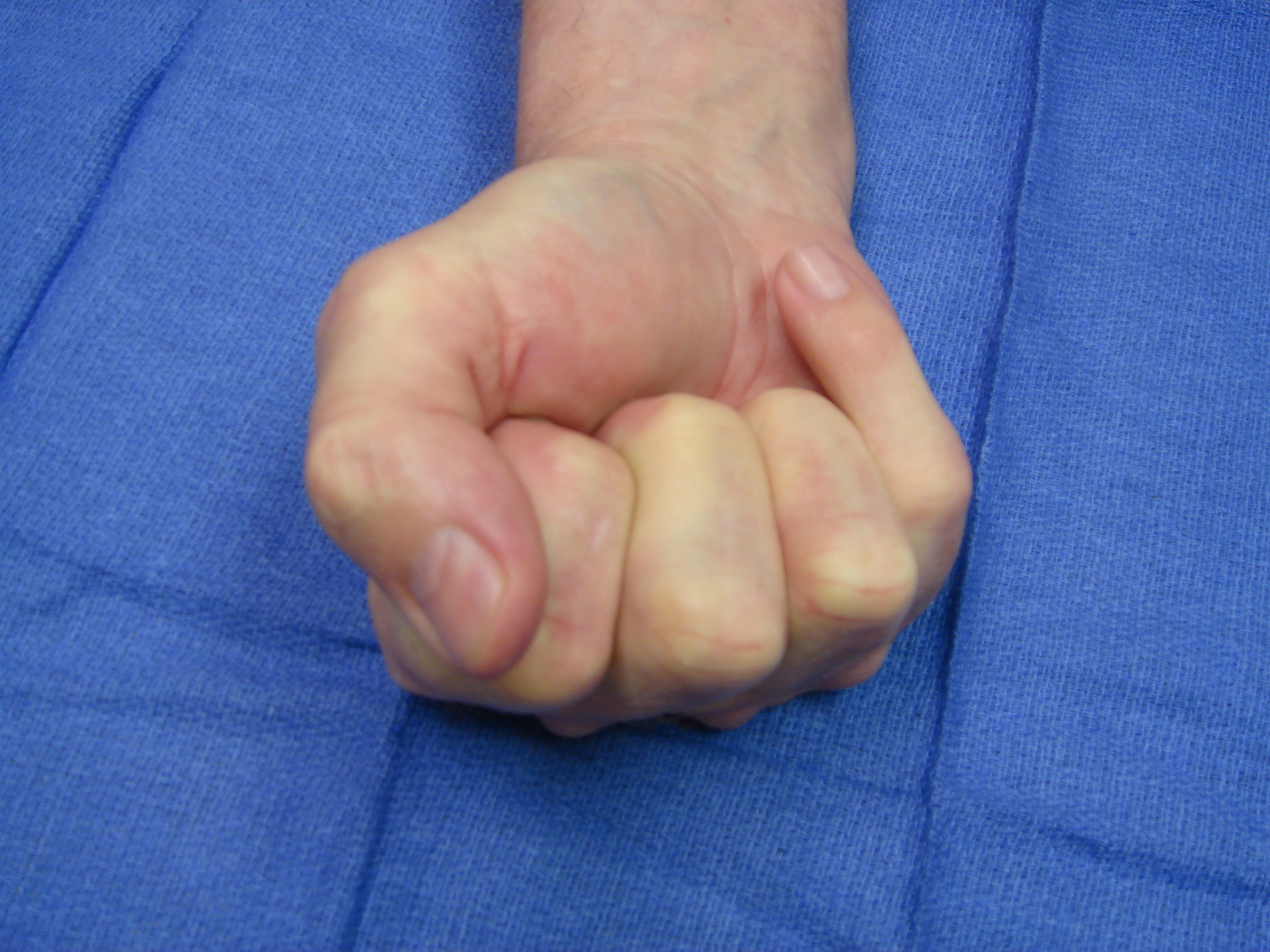 Figure 7: One year after enzyme injection cycle #2 he has maintained finger correction and has useful active flexion (the little finger DIP joint is stiff from osteoarthritis). He reports holding his wife’s hand whenever he wants.