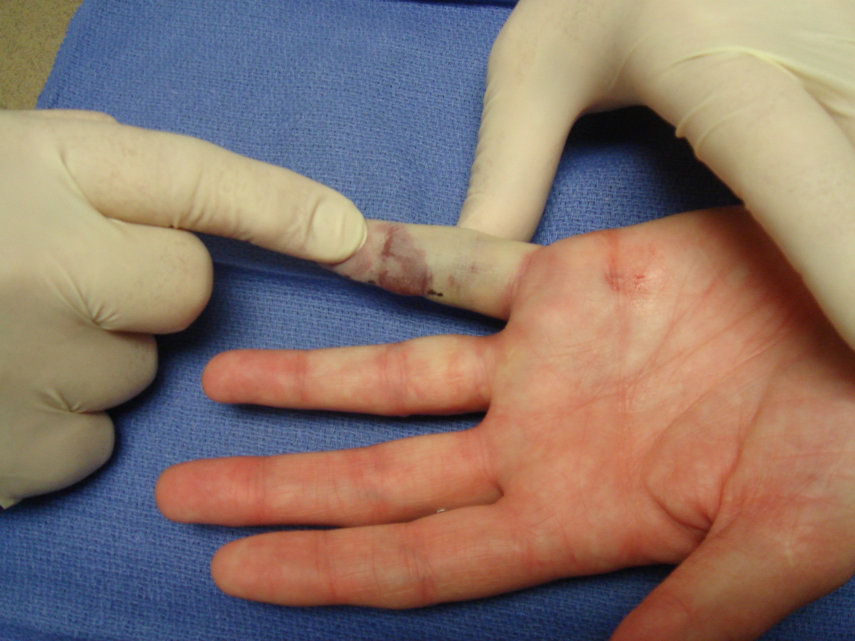 Figure 8c: Post-manipulation, fingers with interphalangeal contractures (and some others) are sometimes transiently but notably vasospastic, but this will resolve within minutes.