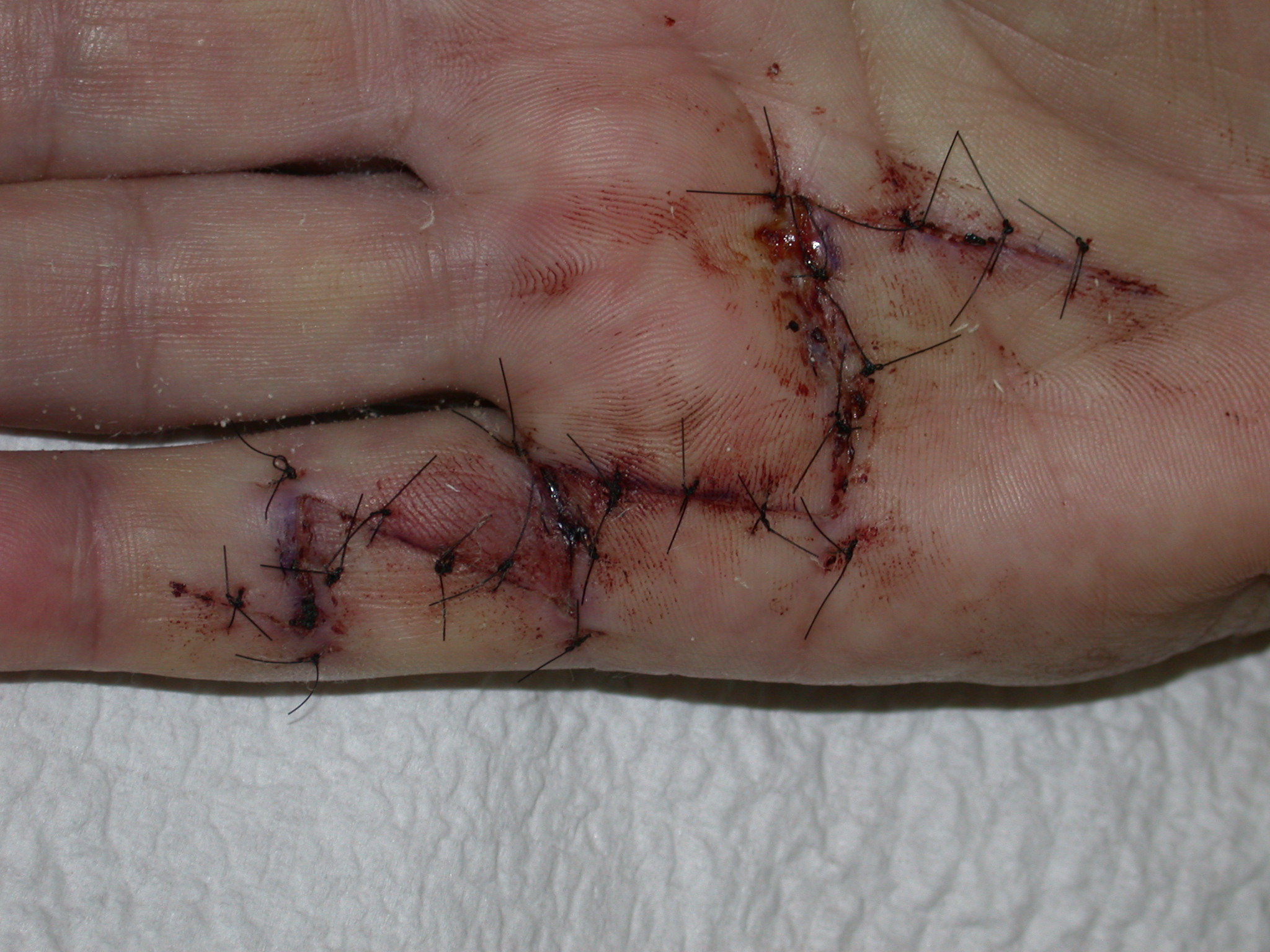 Figures 11b: The ÿãmodified Brunerÿâ incision with primary closure and follow-up at six weeks