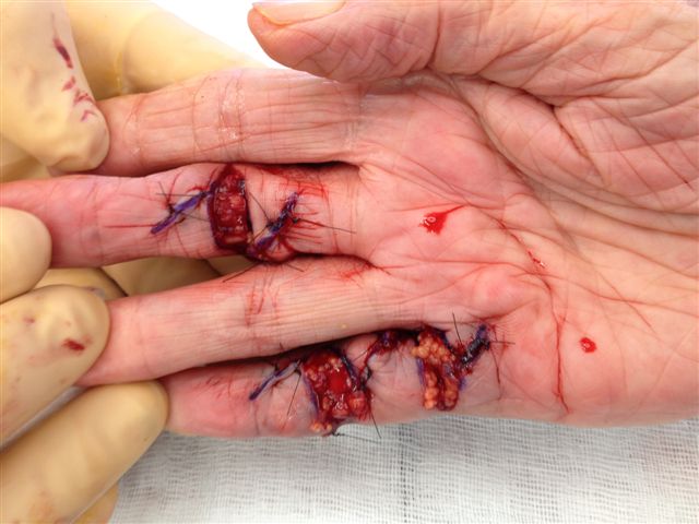 Figures 13c: The ÿãmodified Brunerÿâ incision with the transverse wounds left open. Note that a small area of exposed flexor tendon (as seen in 13a) heals very well with dressings