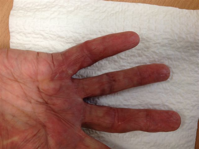 Figures 14d: Patients treated with the open wound technique showing fine scars at follow-up