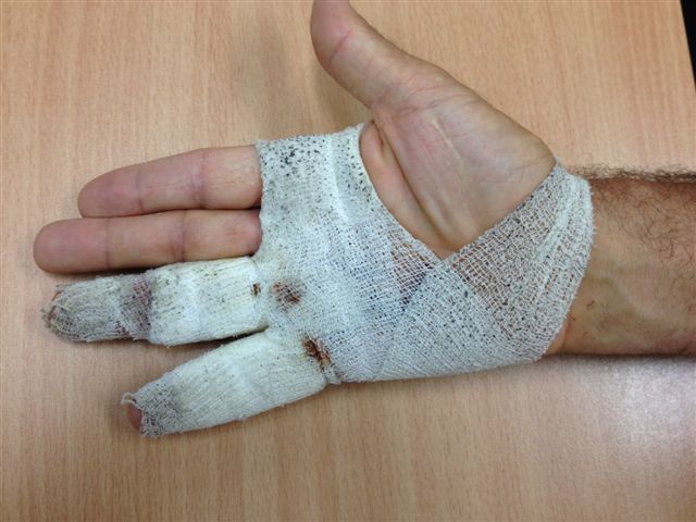 Figure 16: The light dressing applied after five to seven days, showing soiling of the dressing by use of the hand, which is encouraged.