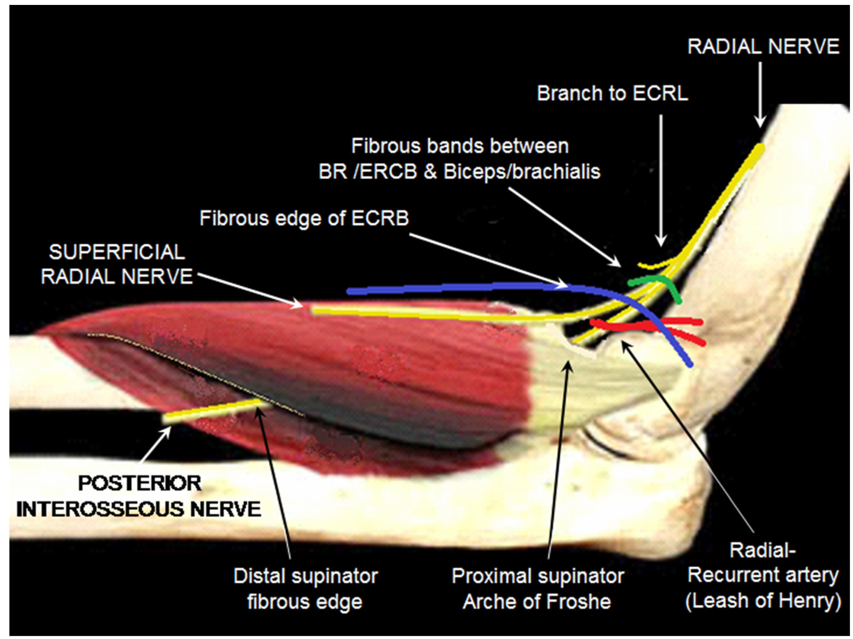 Figure 1: Possible sites of compression of radial and posterior interosseous nerve around the elbow