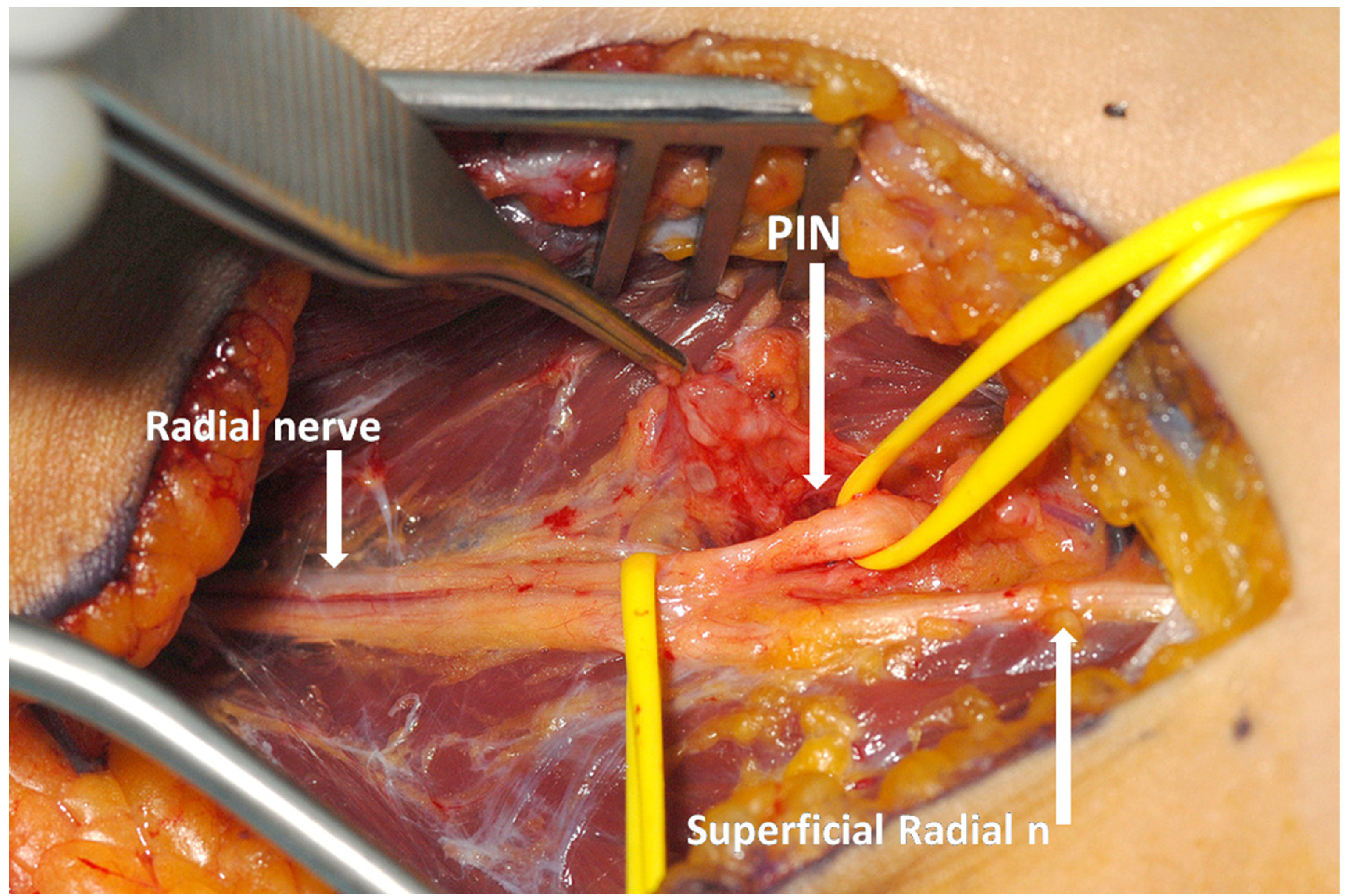Figure 3a: Exploration of the posterior interosseous nerve (PIN) in a patient PIN syndrome. Operative photograph showing exposure of the branches of the radial nerve through a volar approach. 