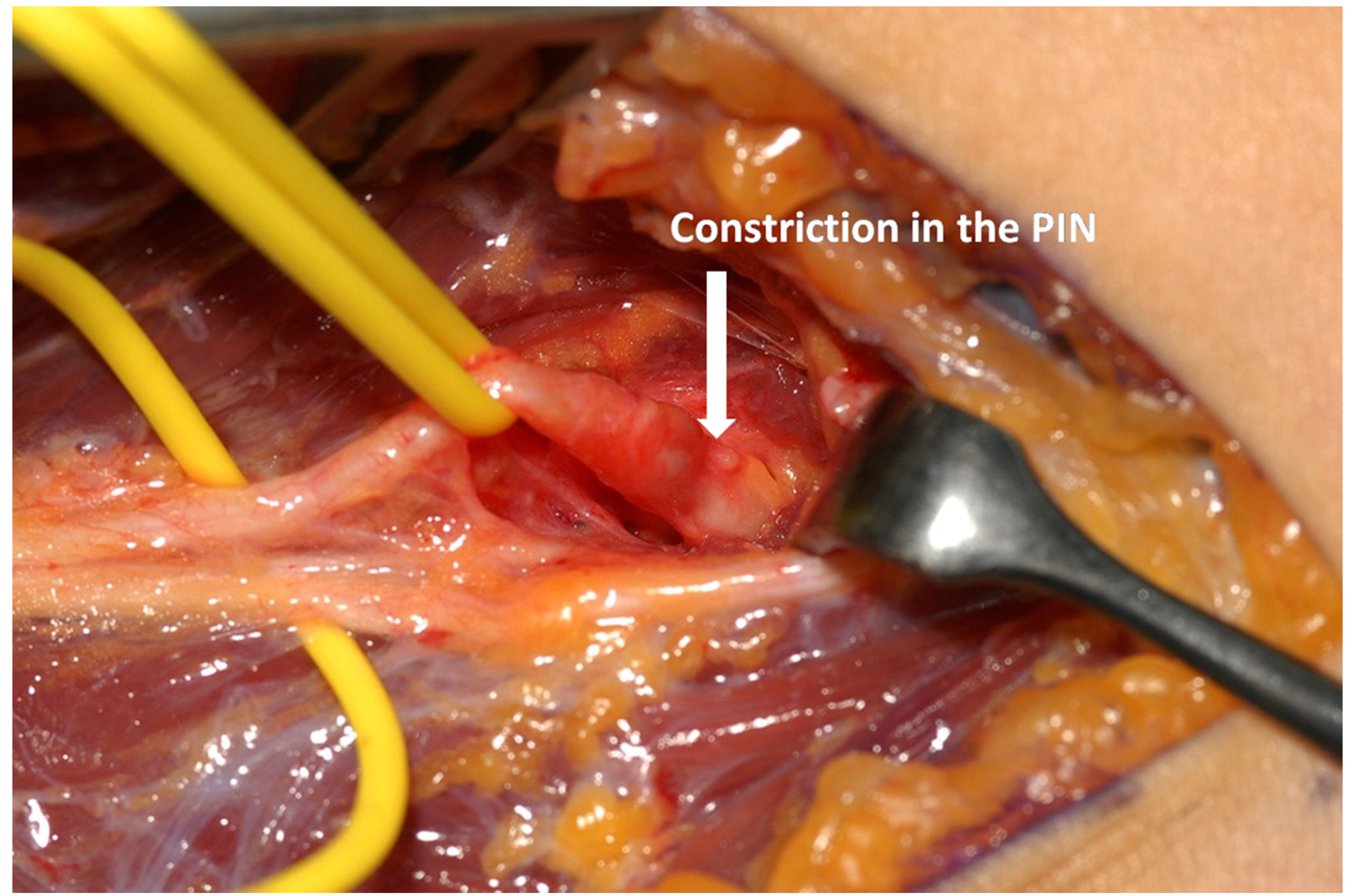 Figure 3b: Exploration of the posterior interosseous nerve (PIN) in a patient PIN syndrome. After tracing the PIN into supinator a constriction was found which required decompression. (Photographs provided by Tim Hems, Queen Elizabeth University Hospital, Glasgow, UK.)