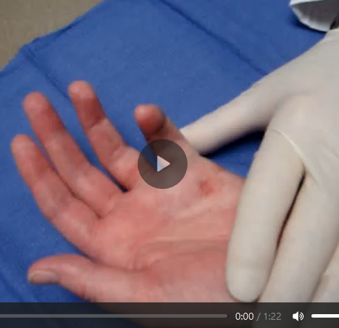 At 48 hours post-collagenase, finger manipulation was performed after anesthetic