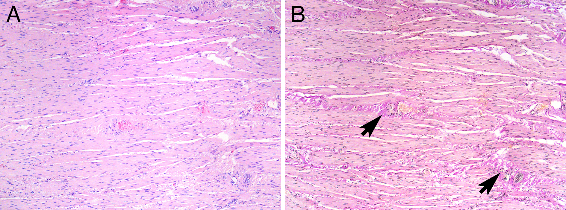 Figure 3a: The detrusor muscle, in this case sparse intra lamellar fibrosis not visualized in routine Htx/eosin. Figure 3b: Same consecutive slide coloured with Van Gieson showing sparse but diffuse intra lamellar fibrosis (arrows). Magnification 100. 